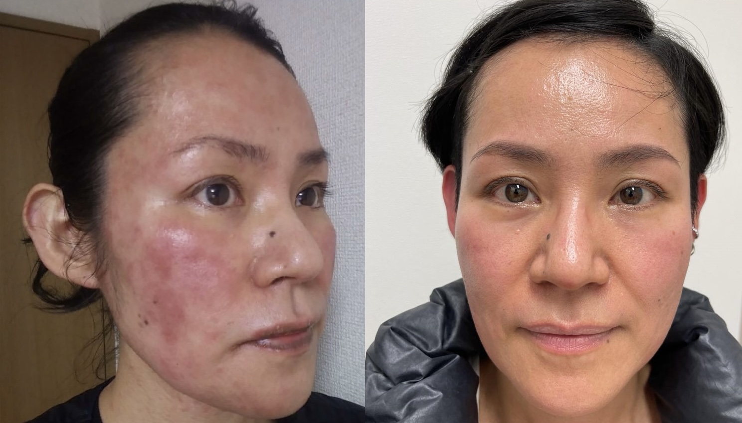 高嶺涼子さんビフォーアフター